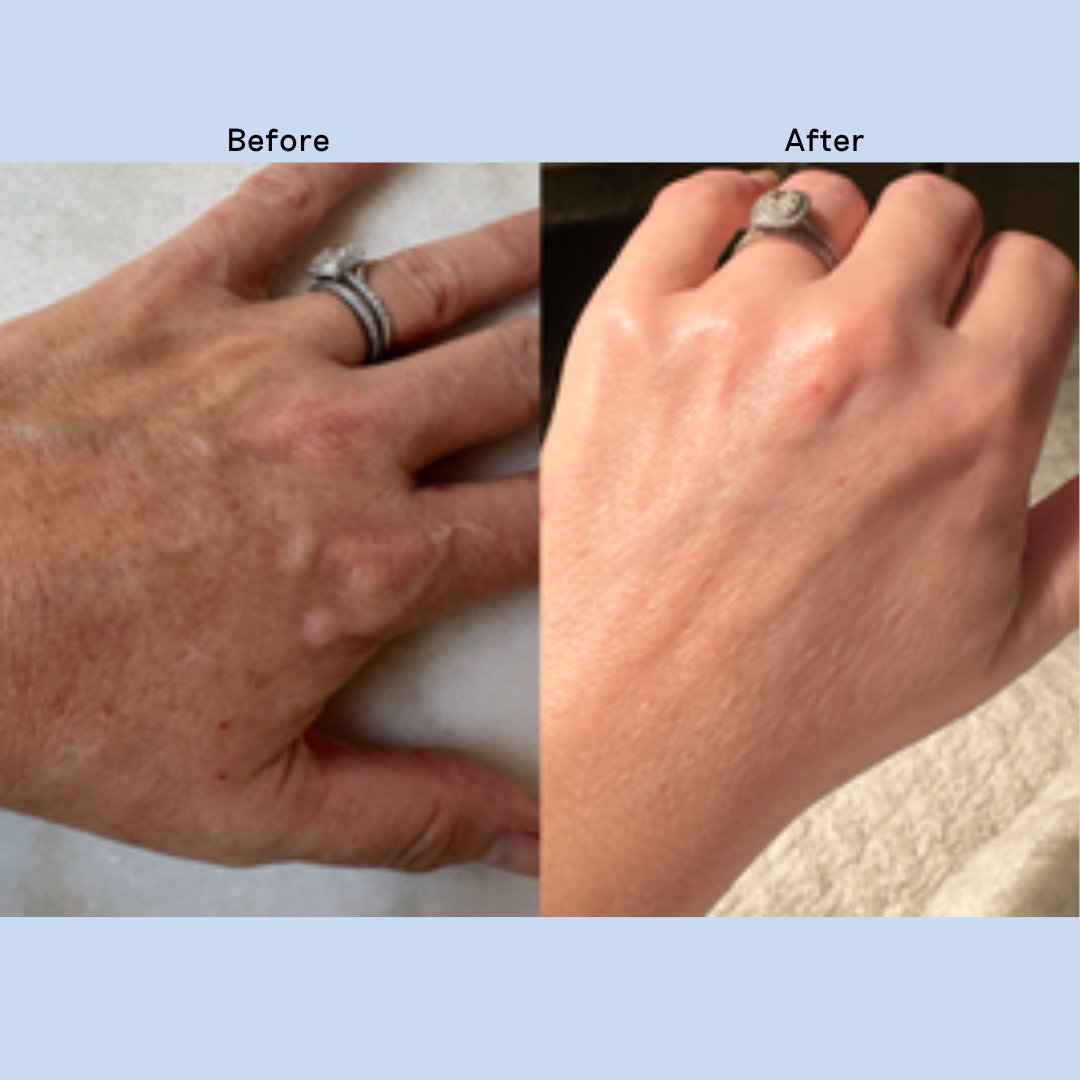 The back of a hand before and after using the Habelo serum and glove regimen